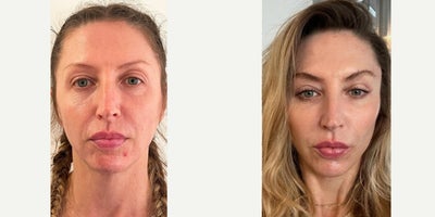 Facial Fat Transfer before and after photo