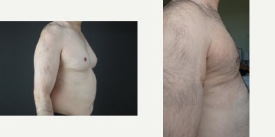 Gynecomastia Surgery before and after photo