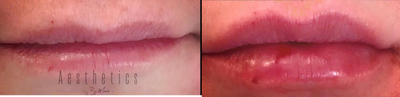 Juvederm before and after photo