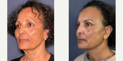 Lower Facelift before and after photo