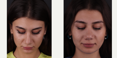 Revision Rhinoplasty before and after photo