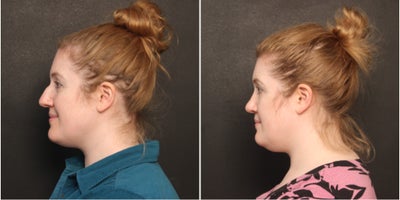 Rhinoplasty before and after photo