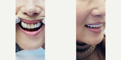 Smile Makeover before and after photo