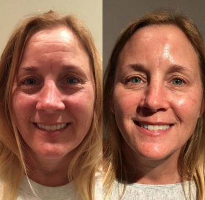 Botox before and after photo
