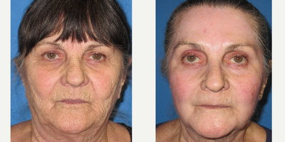 CO2 Laser before and after photo