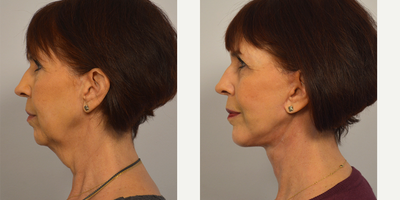 Facelift before and after photo
