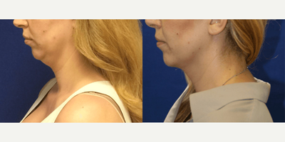 FaceTite before and after photo