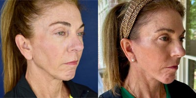 Neck Lift before and after photo