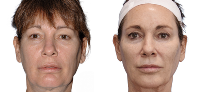 Sculptra before and after photo
