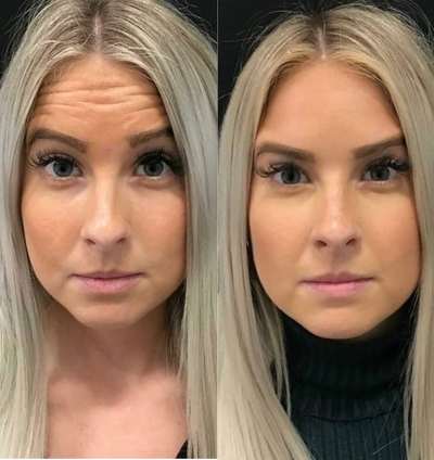 Botox before and after photo