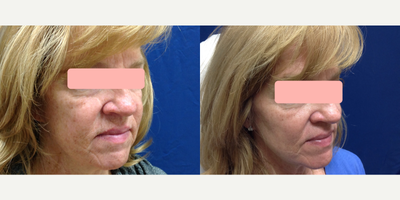 CO2 Laser before and after photo
