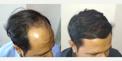 FUE Hair Transplant before and after photo