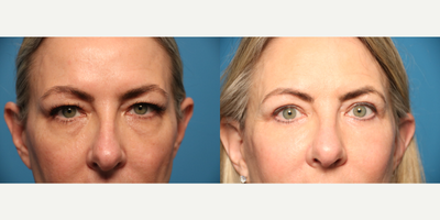 Eyelid Surgery before and after photo