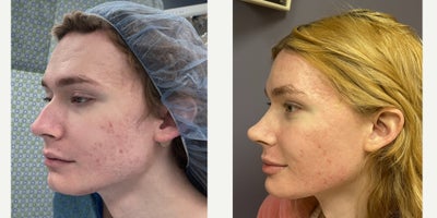 Facial Feminization Surgery before and after photo