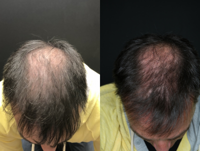 PRP for Hair Loss before and after photo
