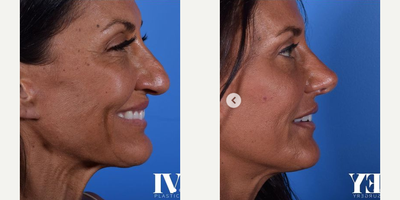 Rhinoplasty before and after photo