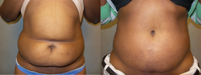 Tummy Tuck before and after photo