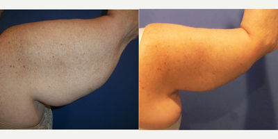 Arm Lift before and after photo