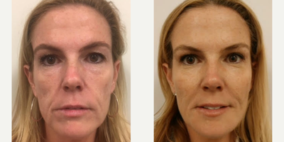 Belotero before and after photo