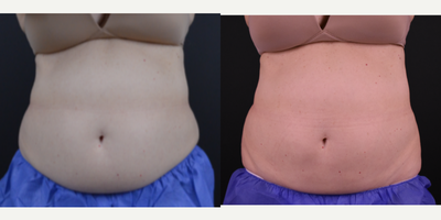 CoolSculpting before and after photo