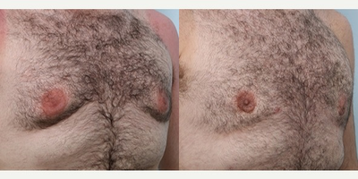 Gynecomastia Surgery before and after photo