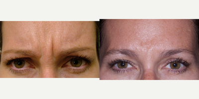 Botox before and after photo