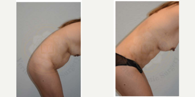 BodyTite before and after photo