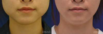 Botox before and after photo