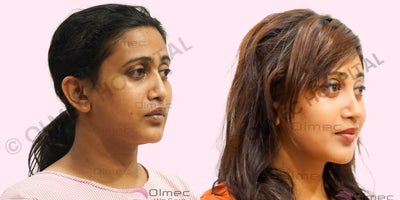 Cheek Augmentation before and after photo