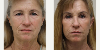 Eyelid Surgery before and after photo