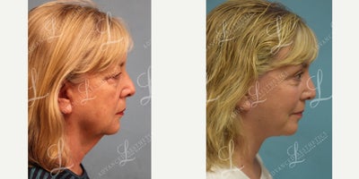 Eyelid Surgery before and after photo