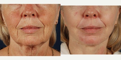 Laser Resurfacing before and after photo