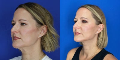Neck Lift before and after photo