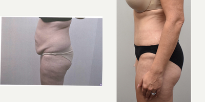 Tummy Tuck before and after photo