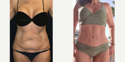 Tummy Tuck before and after photo