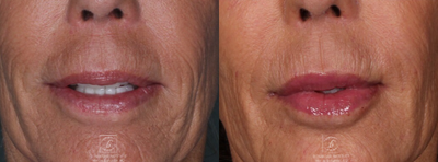 Volbella before and after photo