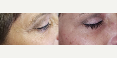 Dysport before and after photo