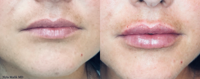 Lip Fillers before and after photo