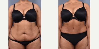Tummy Tuck before and after photo