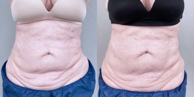 CoolSculpting before and after photo