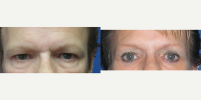 Eyelid Surgery before and after photo