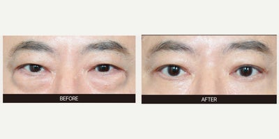 Eyelid Surgery before and after photo