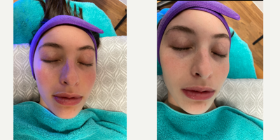 HydraFacial before and after photo