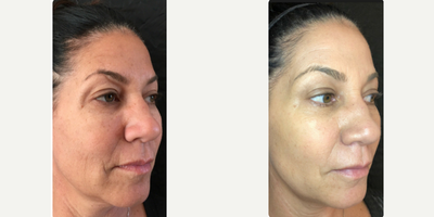 Microneedling before and after photo