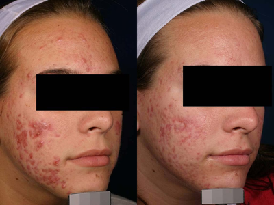 Vbeam before and after photo