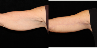 Arm Lift before and after photo