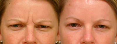Botox before and after photo