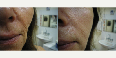 Cheek Augmentation before and after photo