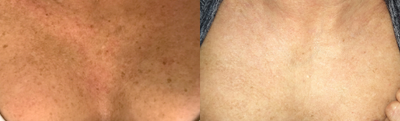IPL before and after photo