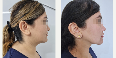 Buccal Fat Removal before and after photo